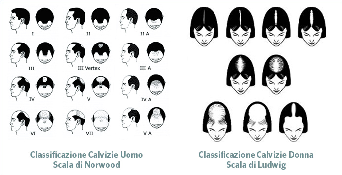 Forme di Alopecie